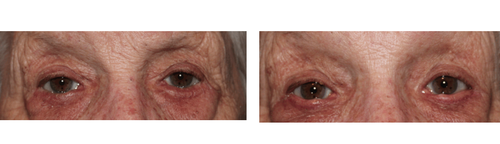 Mileo - Eyelid Repair Procedure - 3