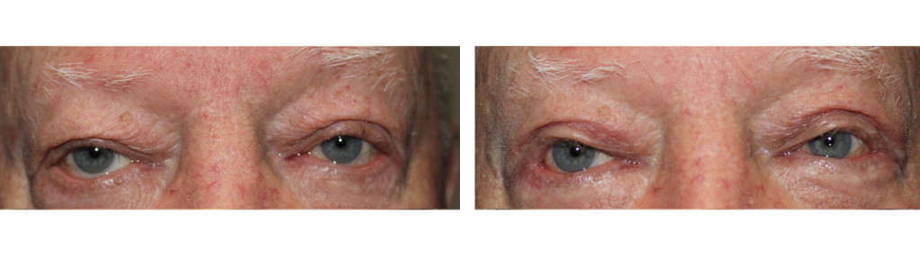 Mileo - Eyelid Repair Procedure - 4