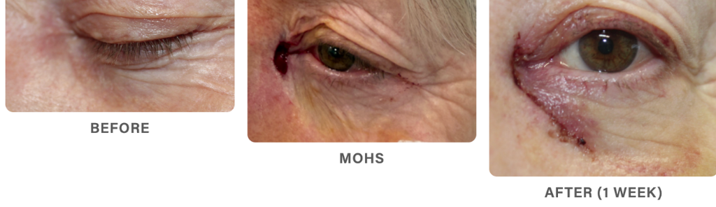 Mileo - Skin Cancer - 1