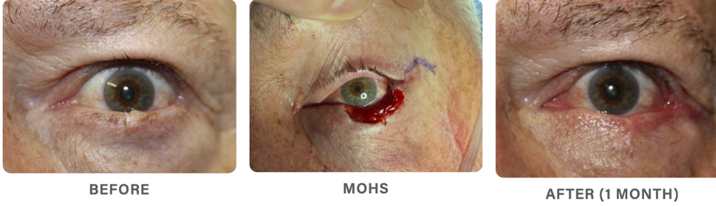 Mileo - Skin Cancer - 2