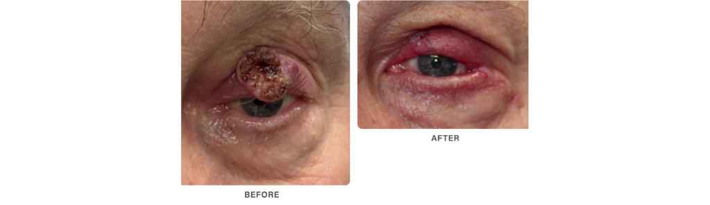 Mileo - Skin Cancer - 4
