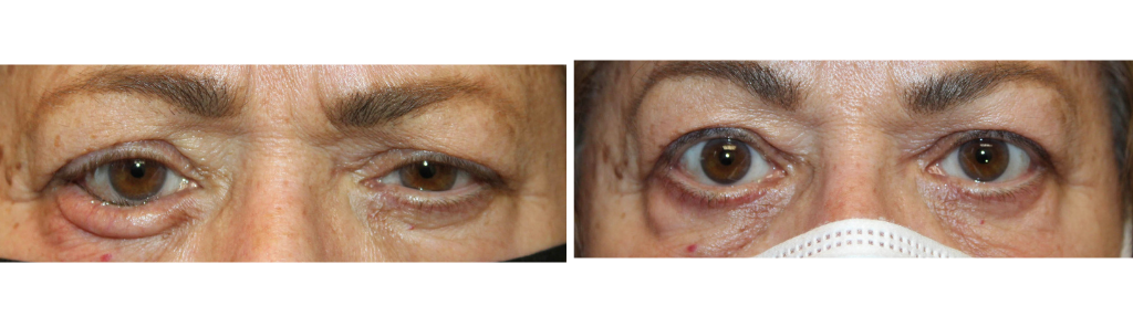 Rafailov - Eyelid Repair Procedure - 1