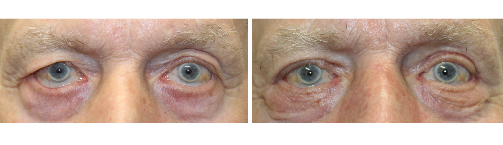 Rafailov - Eyelid Repair Procedure - 2