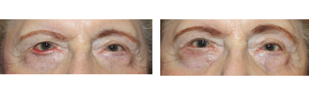 Rafailov - Eyelid Repair Procedure - 3