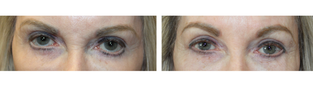 Rafailov - Eyelid Repair Procedure - 4