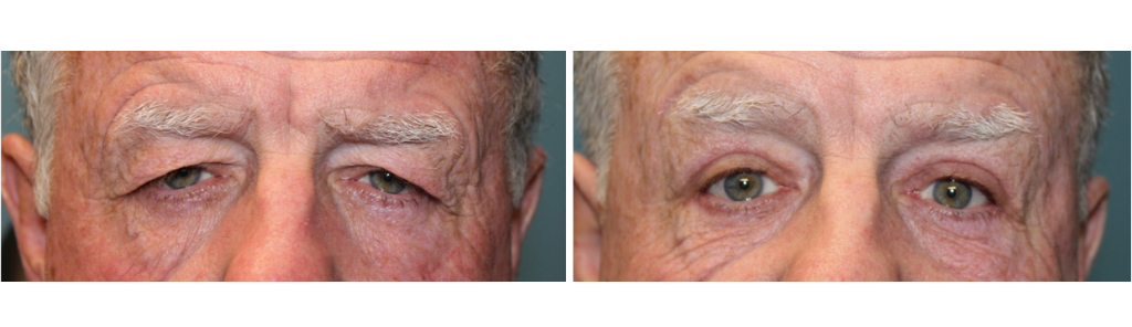 Rafailov - Ptosis Repair - 1
