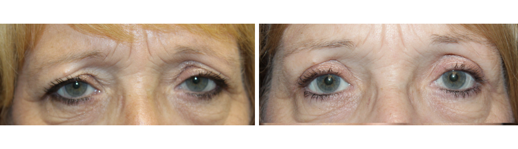 Rafailov - Ptosis Repair - 2