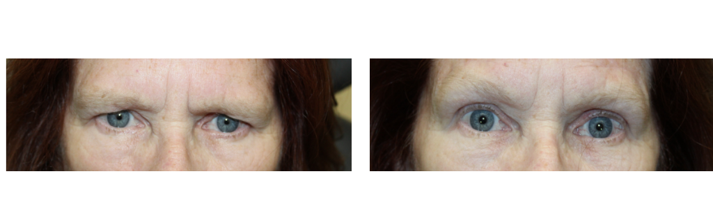 Rafailov - Ptosis Repair - 3