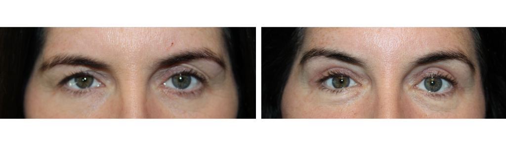 Rafailov - Ptosis Repair - 4