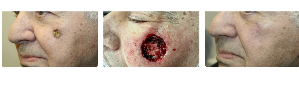 Rafailov - Skin Cancer - 4