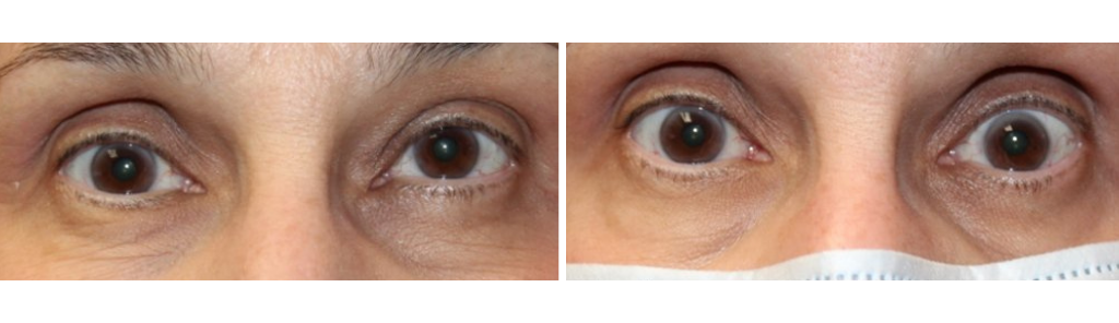 Rafailov - Tumor Removal - 1