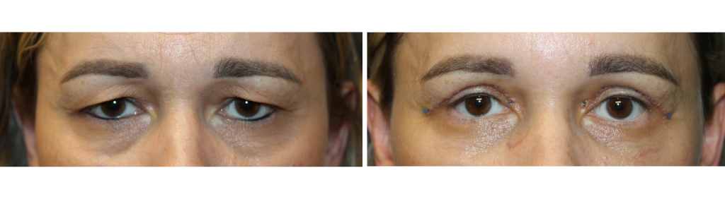 Rafailov blepharoplasty2