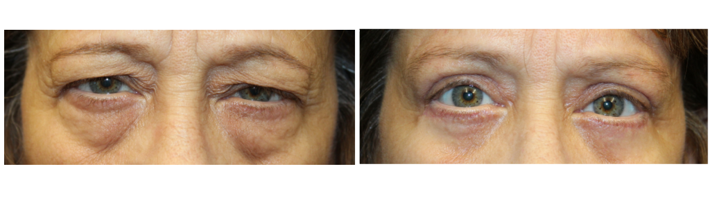 Rafailov blepharoplasty3