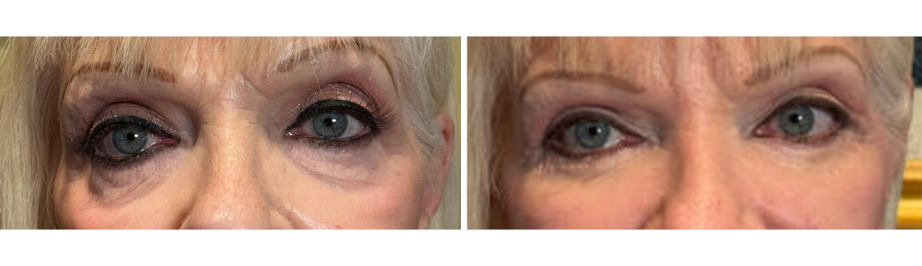 almallah - Lower Eyelid Blepharoplasty BLLs
