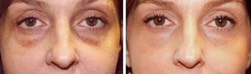 laser-skin-resurfacing-before-after-2-1024x358-1