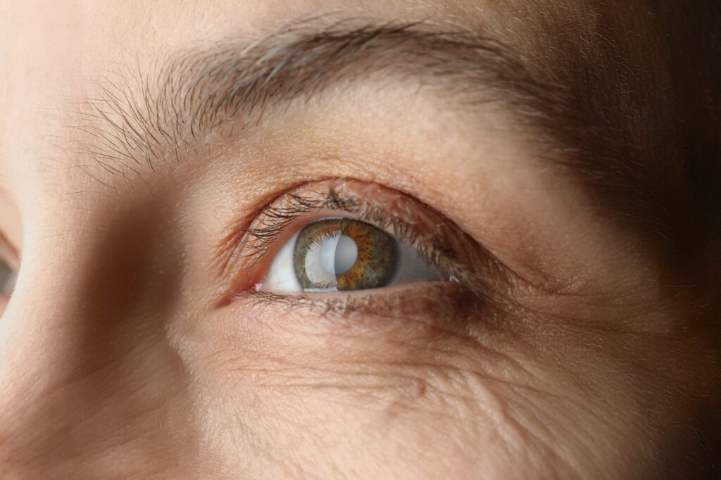 Close-up of a mature woman's eye affected by a cataract, considering cataract surgery