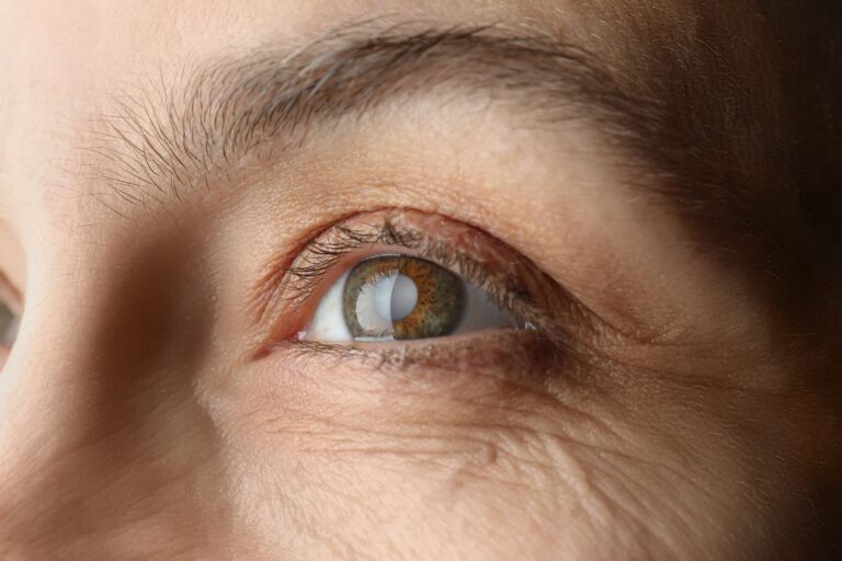 Close-up of a mature woman's eye affected by a cataract, considering cataract surgery