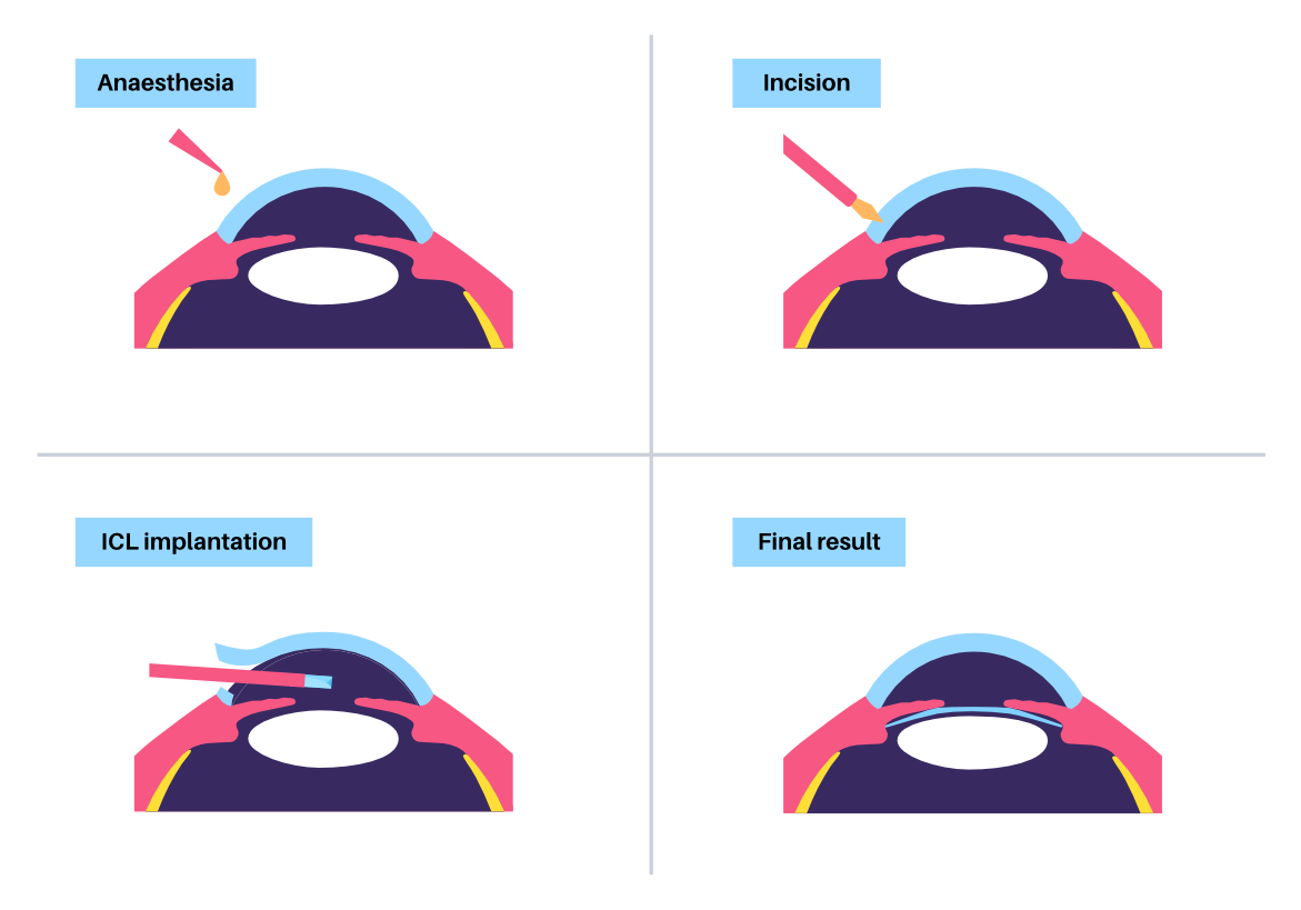 Lens implantation poster. Nearsightedness and astigmatism treatment, healthy eye with minimally invasive procedure EVO ICL. Human visual system anatomy. Cataract surgery