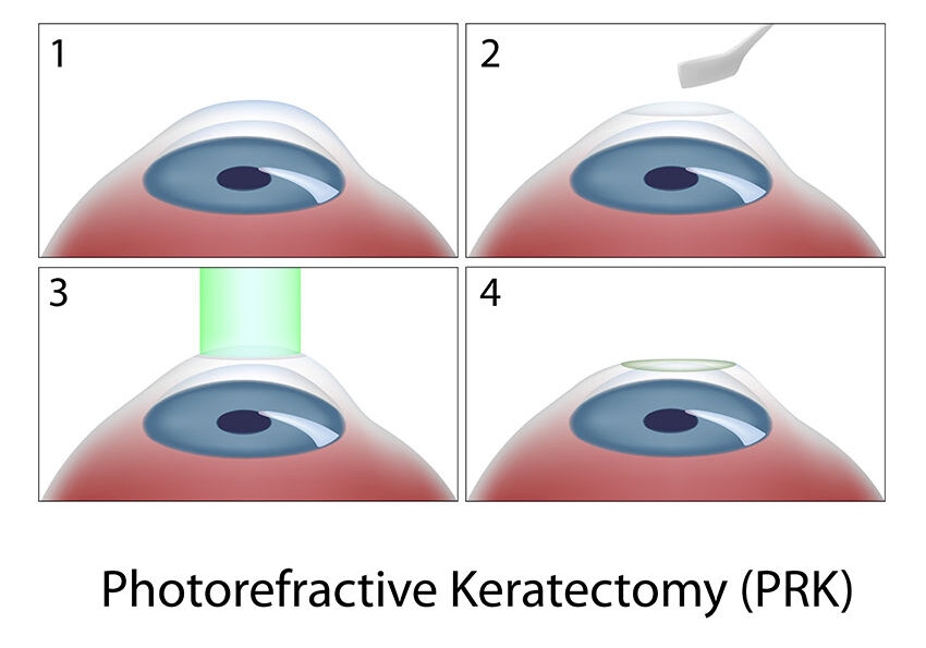 Photorefractive-Keratectomy-(PRK)-surgery